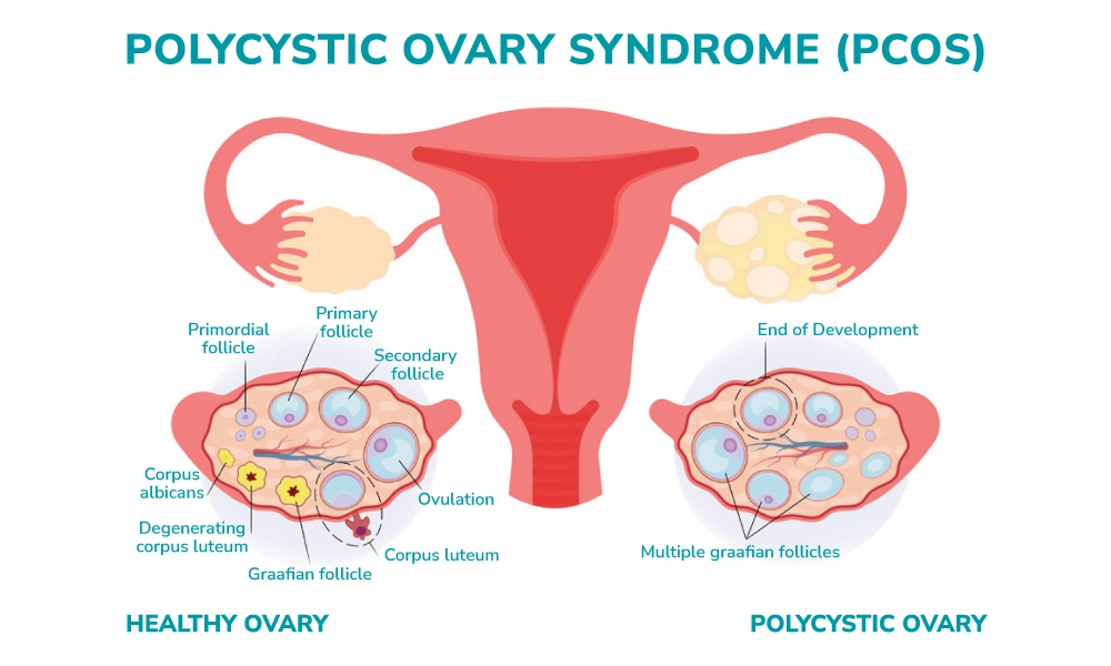 polycystic ovary syndrome illustration 1