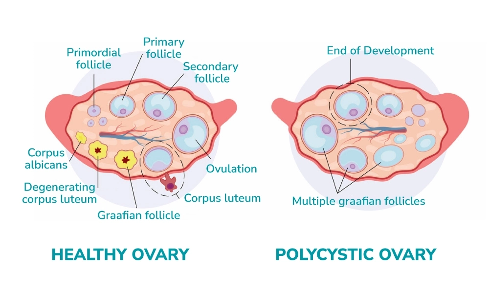 polycystic ovary syndrome illustration 2