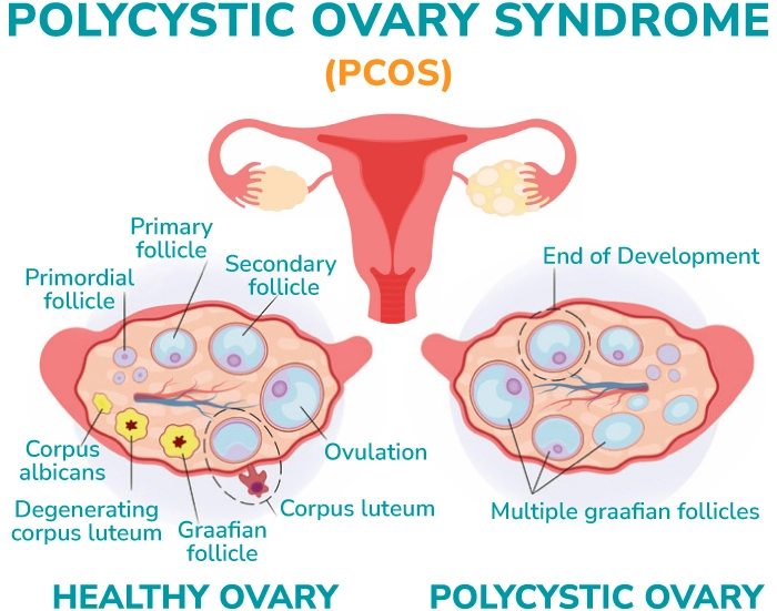 polycystic ovary syndrome illustration 1