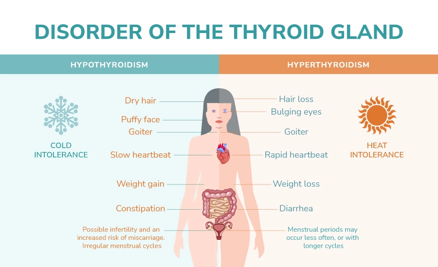 La glande thyroïde est l'organe en forme de papillon situé à l'avant du cou qui sécrète deux types d'hormones : la triiodothyronine (T3) et la thyroxine (T4). Ces hormones régulent le métabolisme de votre corps qui transforme les aliments en énergie. La glande thyroïde est contrôlée par l'hormone stimulant la thyroïde (TSH), produite par l'hypophyse dans le cerveau.
